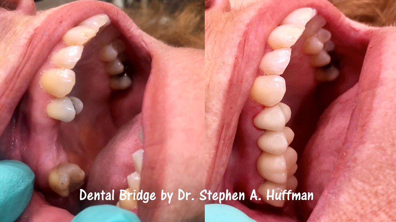 Bridges ⋆ Belpre Dental Studio®