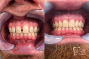 before and after of teeth - smile makeover