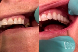 before and after of teeth - smile makeover