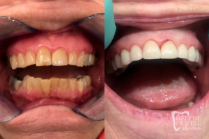 before and after of teeth - smile makeover