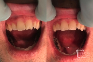 before and after of teeth - smile makeover