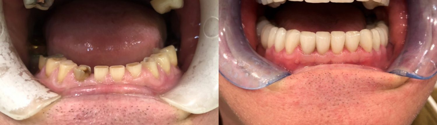 before and after of teeth - smile makeover