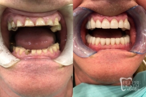 before and after of teeth - smile makeover