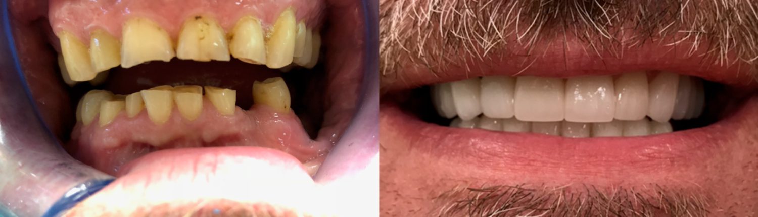 before and after of teeth - smile makeover