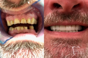 before and after of teeth - smile makeover