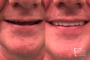 before and after of teeth - smile makeover