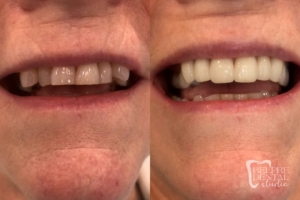 before and after of teeth - smile makeover