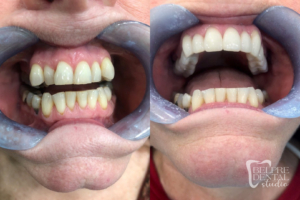 before and after of teeth - smile makeover