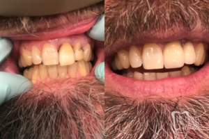 before and after of teeth - smile makeover