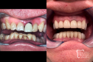 before and after of teeth - smile makeover