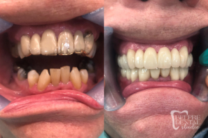 before and after of teeth - smile makeover