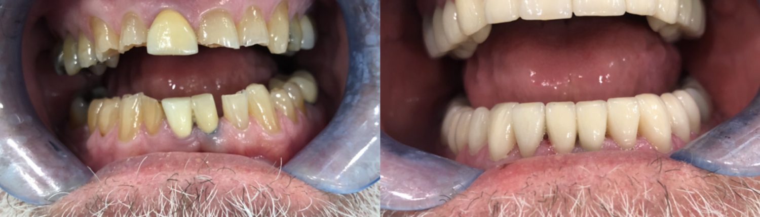 before and after of teeth - smile makeover