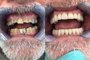 before and after of teeth - smile makeover