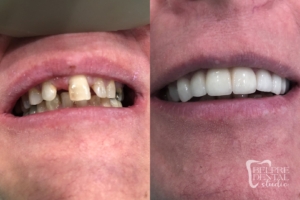 before and after of teeth - smile makeover