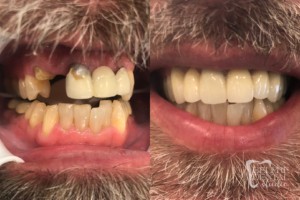 before and after of teeth - smile makeover