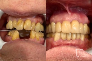 before and after of teeth - smile makeover