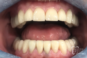 before and after of teeth - smile makeover