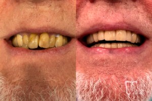 before and after of teeth - smile makeover