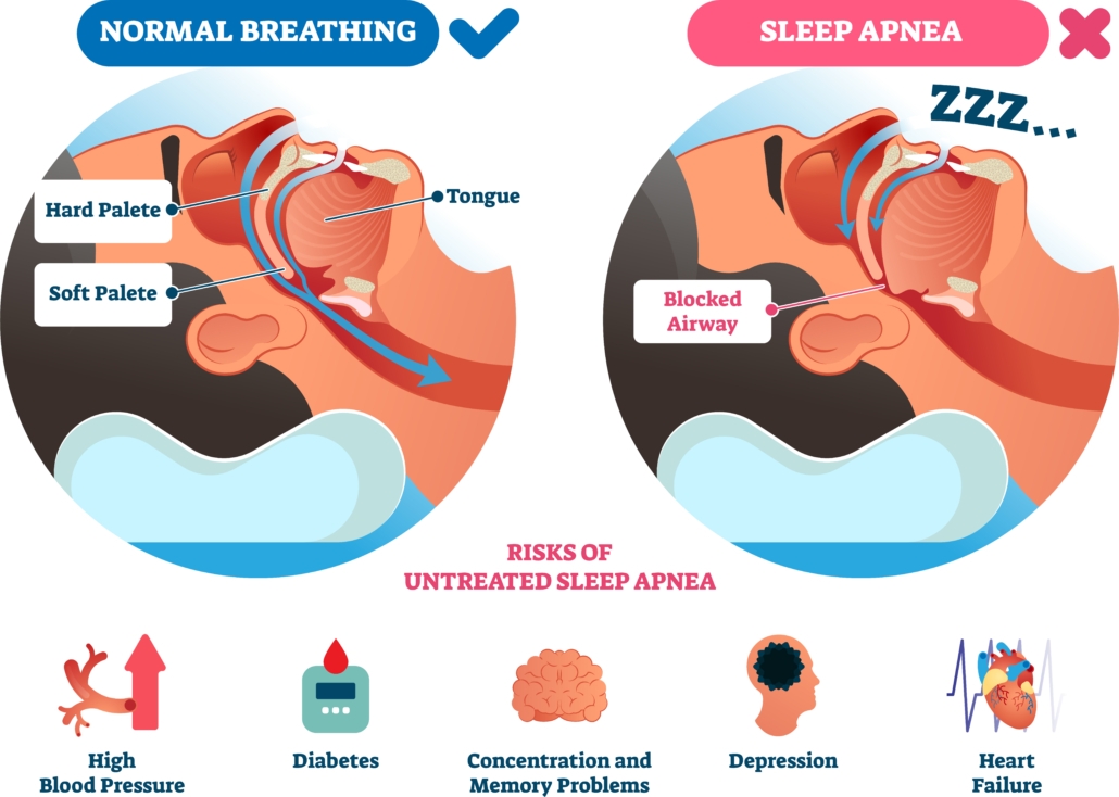 Sleep apnea ⋆ belpre dental studio®