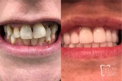 before and after of teeth - smile makeover