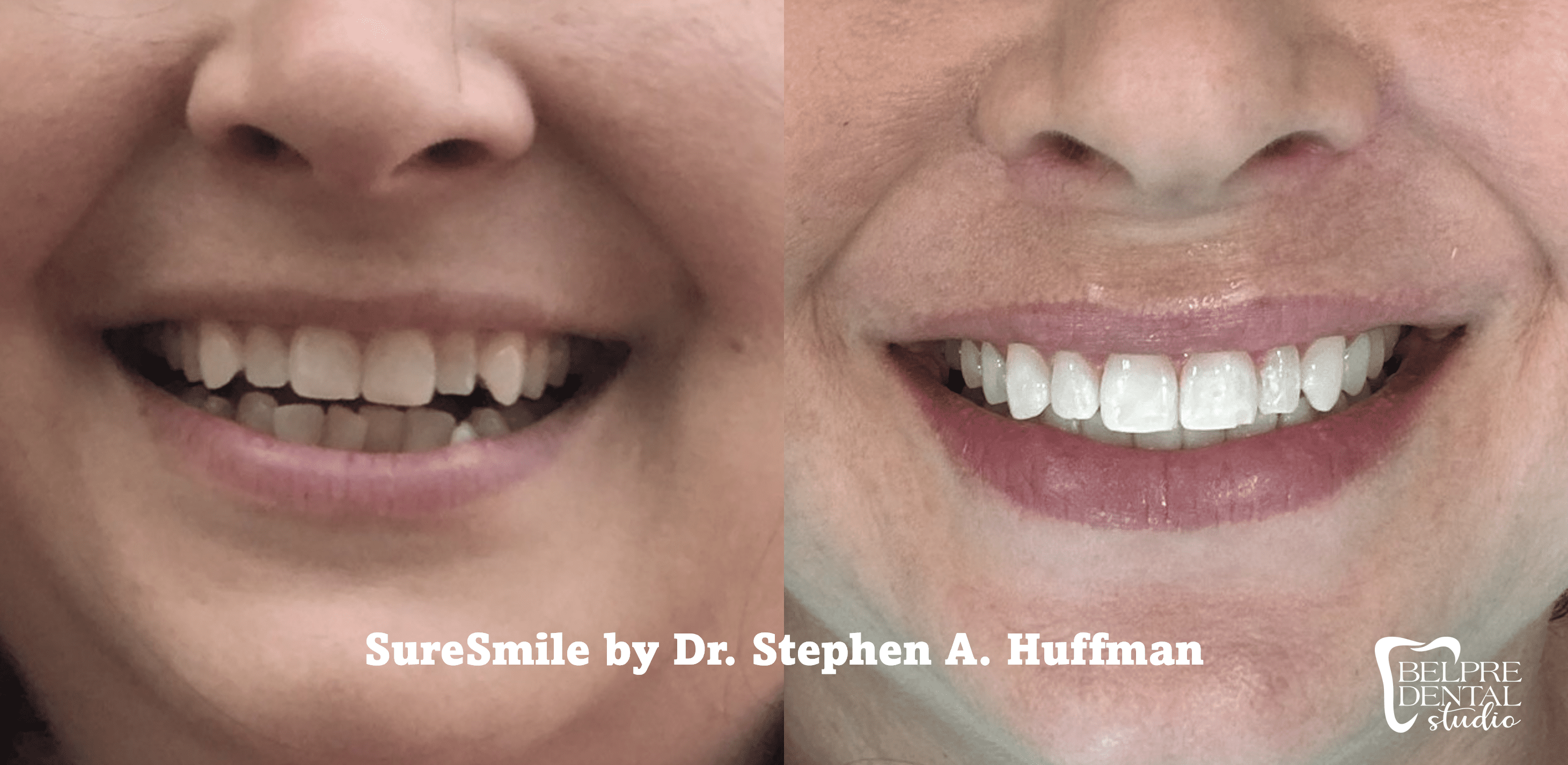 Suresmile-by-Dr.-Huffman-7.12.