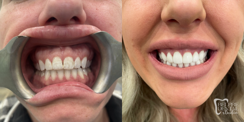 Smile Makeover 1.14.26