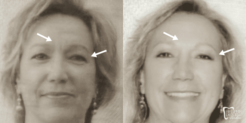 Botox and Juvederm 11s